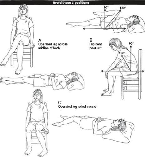 posterior hip precautions handout|Total Hip Replacement / Revision .